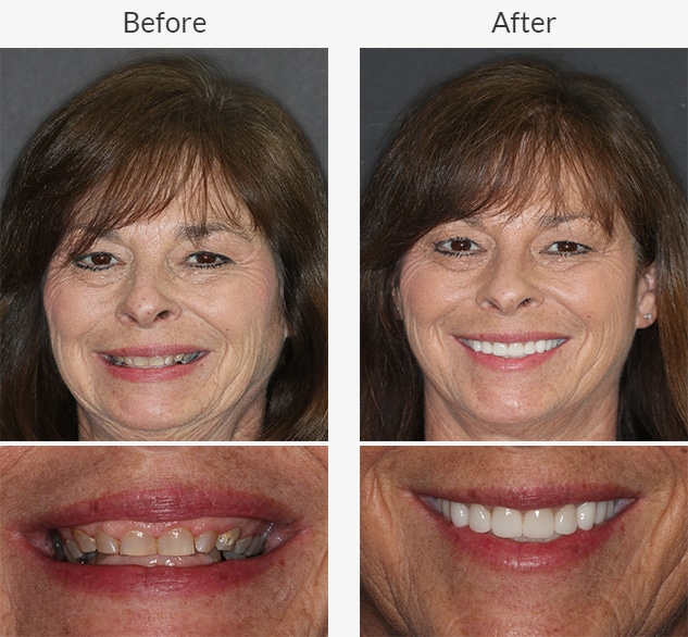 smile close ups and portraits before and after dental treatment