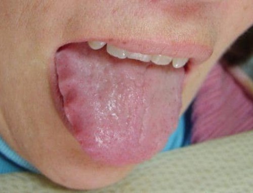 What Does Scalloped Tongue Mean?