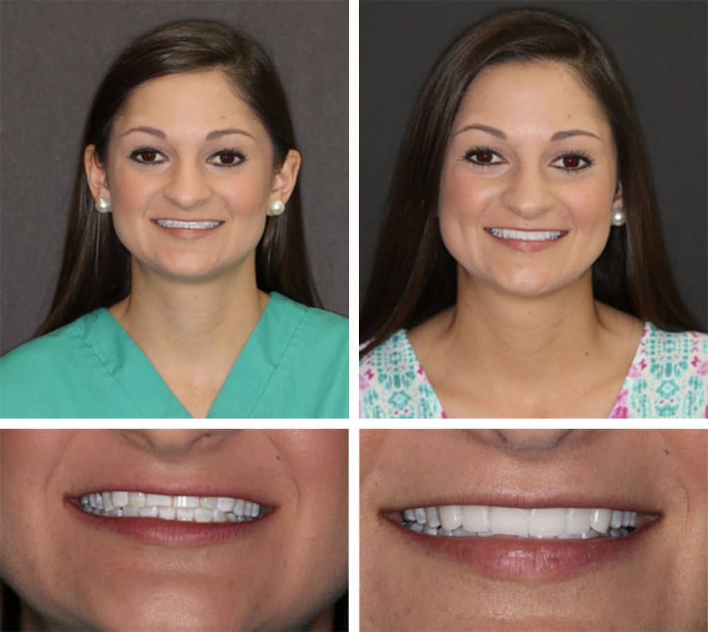 before and after results of full mouth reconstruction, patient of Beyond Exceptional Dentistry 