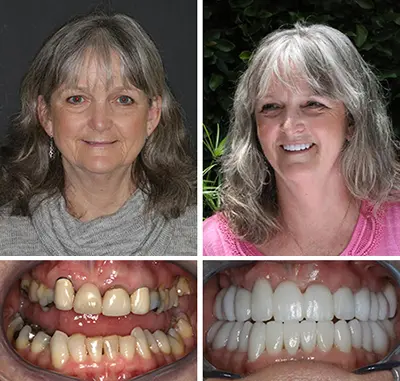 woman showing off before and after cosmetic dentistry smile